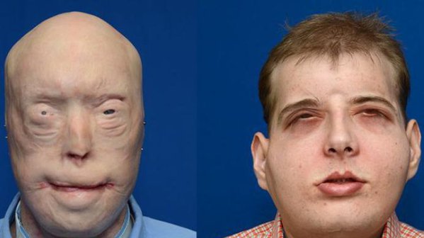 pozharnomu-peresadili-litso-pogibshego-velosipedista-foto-abcnetau_rect_9dbc3619502073e5319c438c7690390b.jpg (37.24 KiB) Просмотров: 5135 pozharnomu-peresadili-litso-pogibshego-velosipedista-foto-abcnetau_rect_9dbc3619502073e5319c438c7690390b.jpg